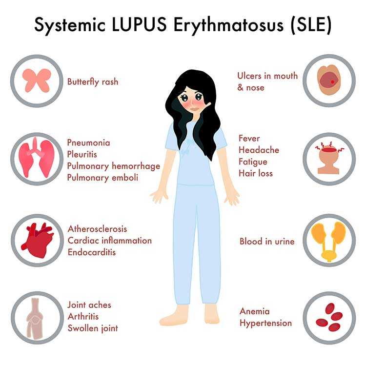 what is lupus disease